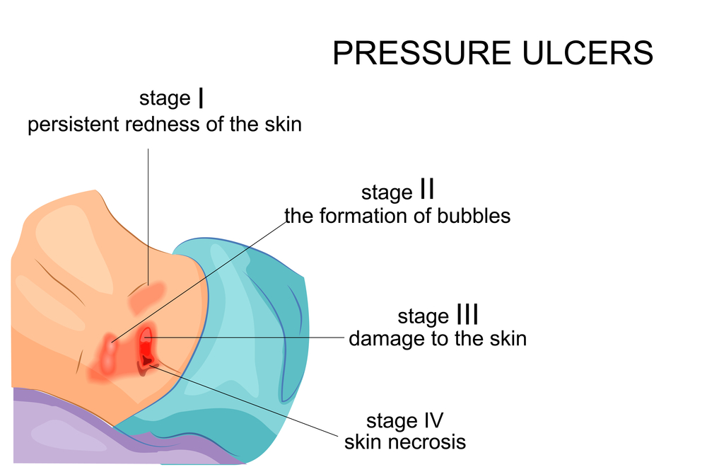 Diagram of stages of bedsore development